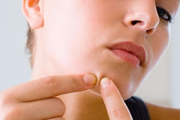 Tự ý nặn mụn ẩn tại nhà sai cách có thể gây nhiễm trùng vùng da của bạn